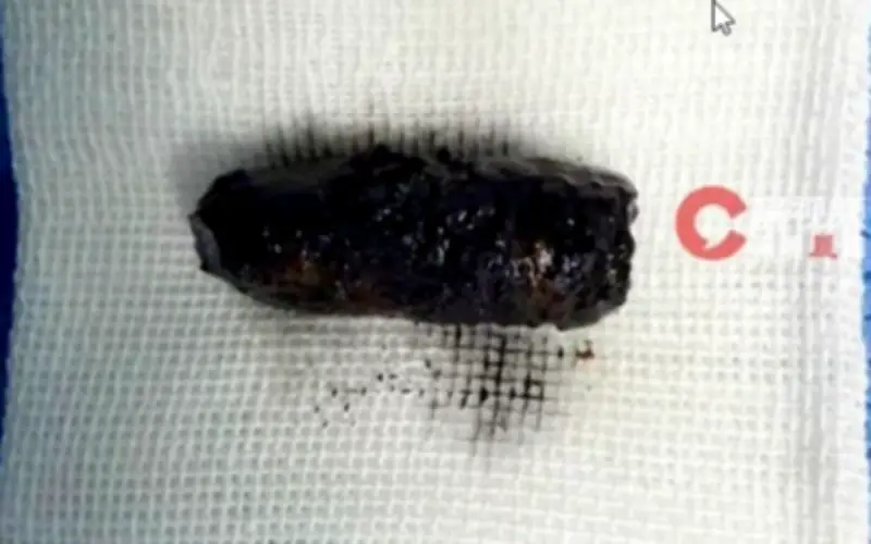 Người đàn ông Trung Quốc sống chung với ốc vít trong mũi suốt 40 năm