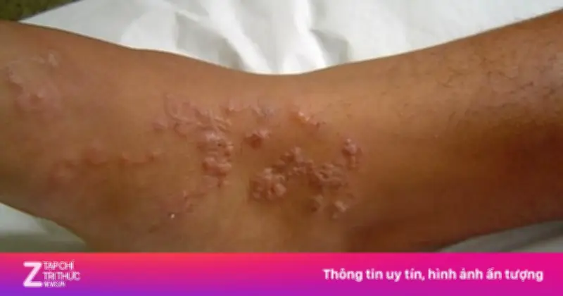 Người phụ nữ ngứa toàn thân suốt 2 năm, bất ngờ phát hiện nhiễm sán dây chó
