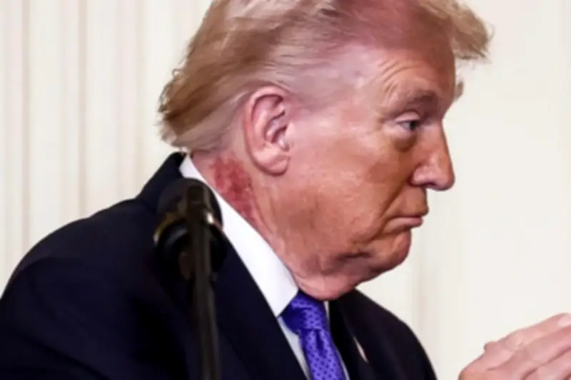 Nhà Trắng giải thích vết bầm đỏ trên cổ Tổng thống Mỹ Joe Biden