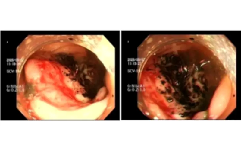 Nhiều người trẻ 9X phát hiện ung thư đại trực tràng giai đoạn nặng do áp lực công việc