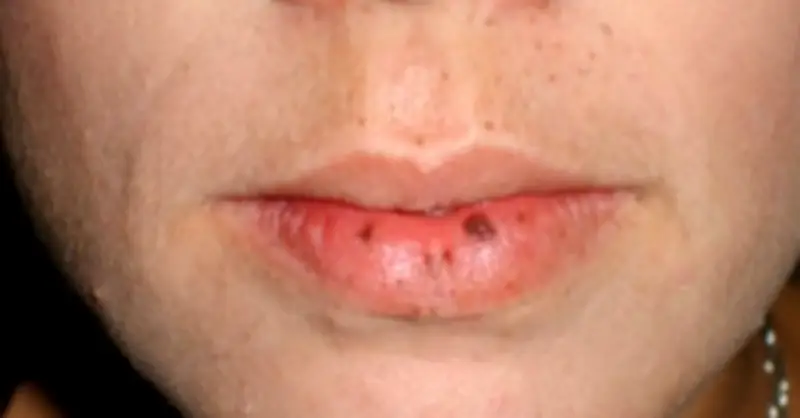 Nốt Đen Trên Môi Hé Lộ Bệnh Di Truyền Gây Ung Thư Trong Gia Đình
