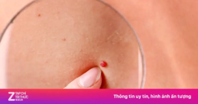 Nốt ruồi đỏ xuất hiện đột ngột: Dấu hiệu bệnh lý hay chỉ là lão hóa?