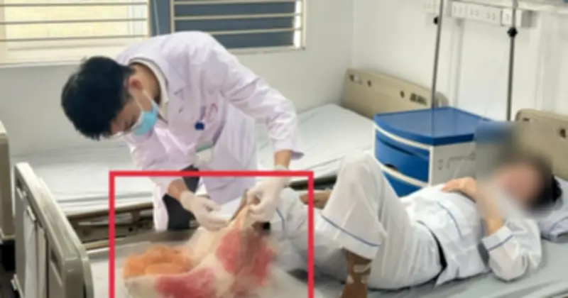 Đắp lá chữa bỏng suốt một tháng, người đàn ông suýt mất chân vì hoại tử xương