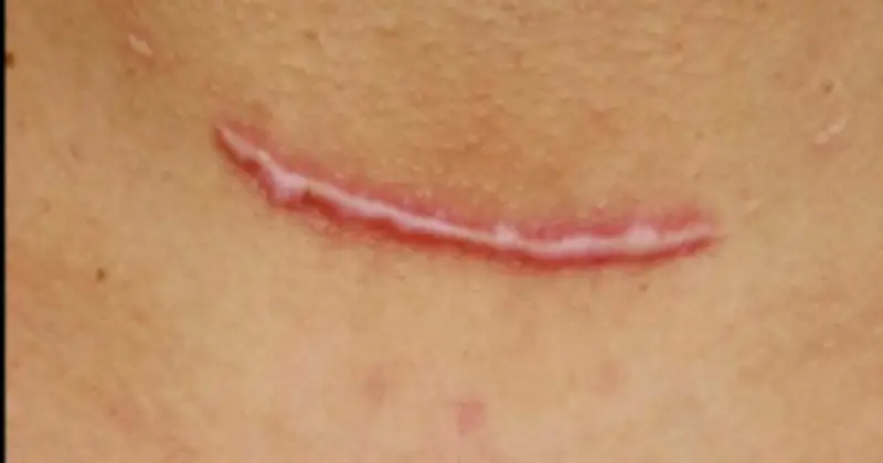 Áp Lực Cơ Học: Yếu Tố Quan Trọng Trong Hình Thành Sẹo Và Cách Phòng Ngừa