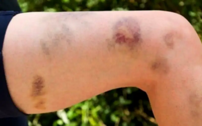 Phụ nữ 40 tuổi khỏe mạnh nguy kịch sau 2 tháng dùng thuốc sai cách