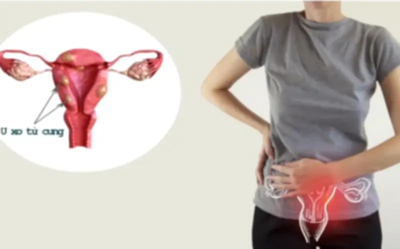 Phụ nữ 45 tuổi thoát khối u xơ tử cung nhờ kỹ thuật quân đội tiên tiến