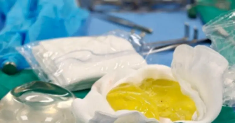 Phụ nữ Hà Nội trải qua ca phẫu thuật thay túi ngực sau khi phát hiện vỡ túi độn thầm lặng