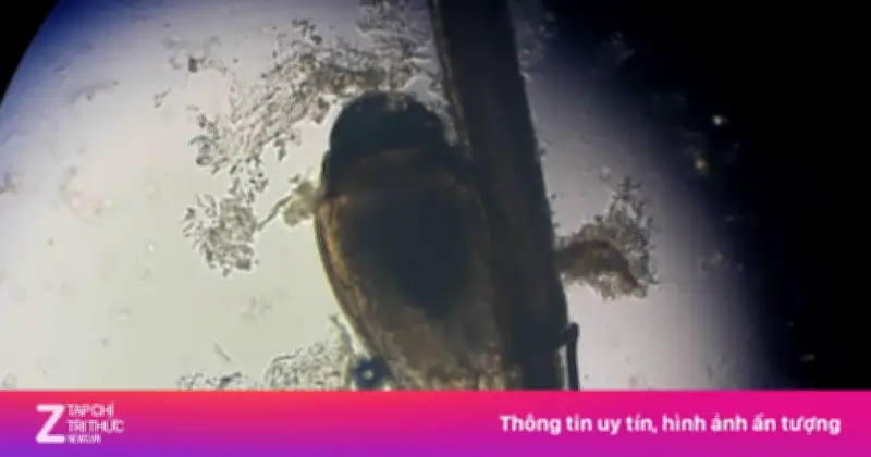 Rùng mình phát hiện ổ rận mu lúc nhúc ký sinh trên lông mi người phụ nữ