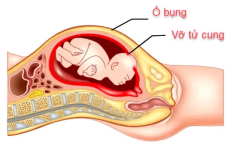 Sản phụ 29 tuổi tử vong trong đêm, thừa nhận sai lầm nhiều phụ nữ Việt mắc phải