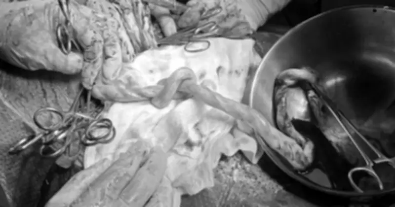 Sản phụ và bé trai khỏe mạnh sau ca phẫu thuật khẩn cấp do dây rốn thắt nút