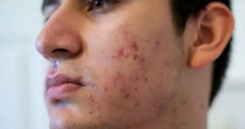 Sẹo Rỗ Ở Nam Giới: Có Thể Tự Cải Thiện Nhờ Tăng Sinh Collagen?