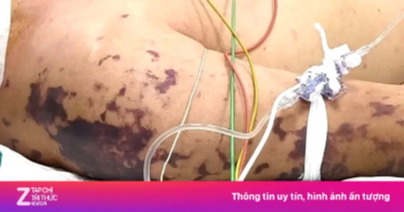 Từ Sốt Cảm Cúm Đến Sốc Nhiễm Trùng: Người Phụ Nữ Suýt Mất Mạng Vì Não Mô Cầu