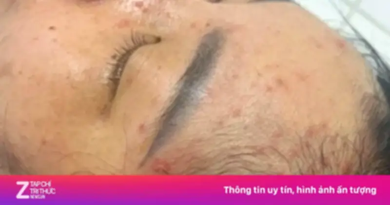 Thai phụ 18 tuần nhập viện vì thủy đậu sau tiếp xúc trẻ mắc bệnh tại trường mầm non