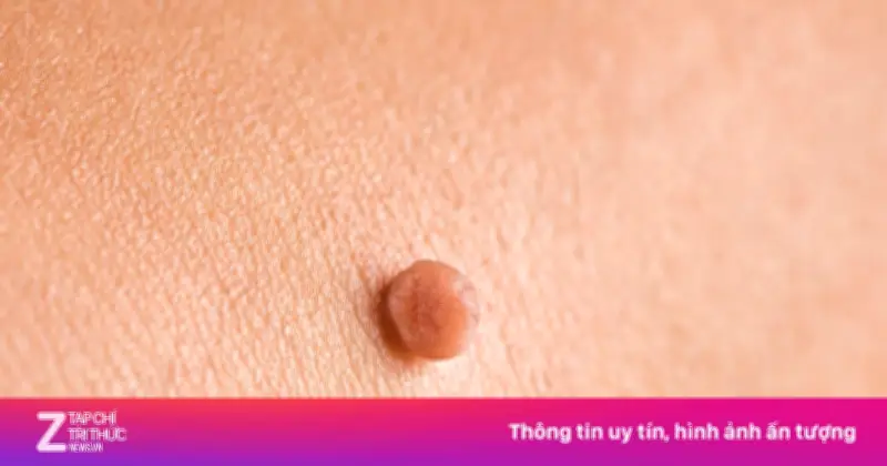 Thai Phụ 20 Tuổi Mắc Sùi Mào Gà: Cảnh Báo Nguy Cơ Lan Nhanh Trong Thai Kỳ