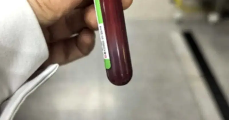 Thai phụ suýt mất mạng vì ăn gà rán, hamburger suốt tuần, máu trắng như sữa