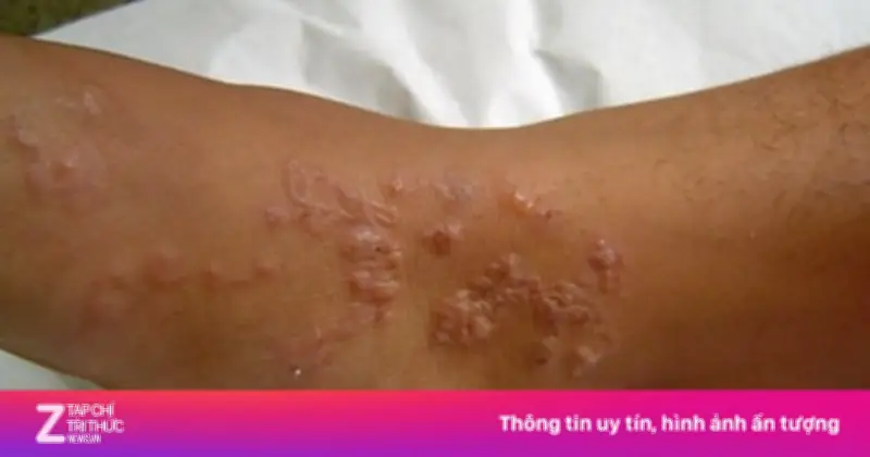 Thanh niên nhiễm cùng lúc 3 loại ký sinh trùng do thói quen ăn uống thiếu vệ sinh