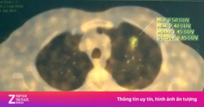 Thói Quen Hút Thuốc Lâu Năm Dẫn Đến Ung Thư Phổi, May Mắn Phát Hiện Sớm Nhờ AI