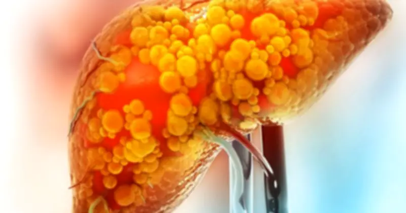 Thói Quen Ngủ Muộn: Tác Nhân Âm Thầm Gây Gan Nhiễm Mỡ Ở Người Trẻ