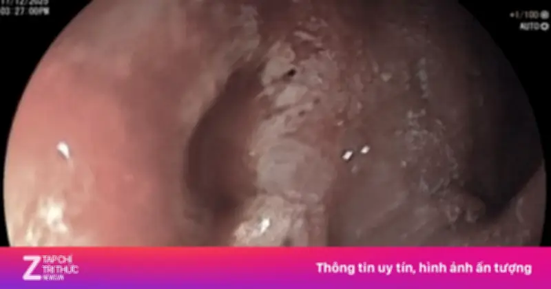 Thói quen 'tự hủy' dạ dày ở giới trẻ: Bệnh viện 115 ghi nhận 40 ca xuất huyết tiêu hóa