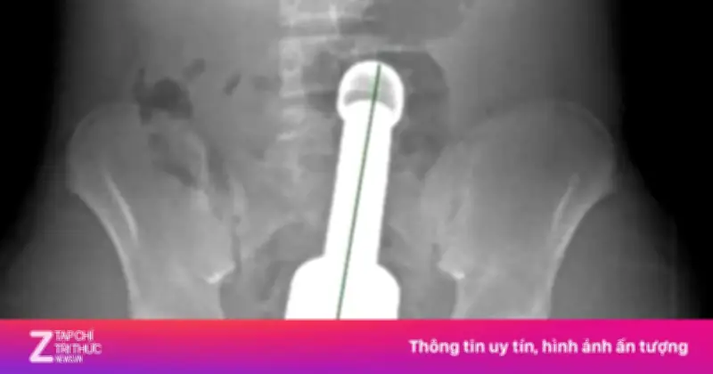 Thiếu niên 15 tuổi cấp cứu vì chiếc chày 18 cm mắc kẹt trong hậu môn