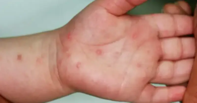 TP HCM: Bệnh tay chân miệng tăng mạnh từ tuần 9/2026, xuất hiện chủng virus nguy hiểm