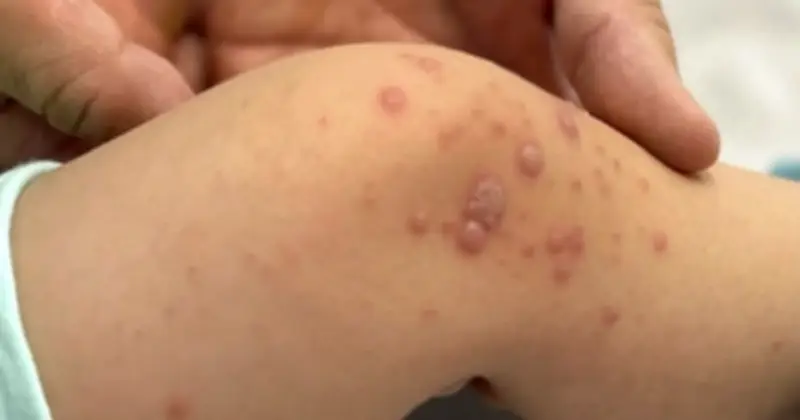 TP.HCM: Bệnh tay chân miệng bùng phát mạnh, số ca nặng tăng hơn 240%