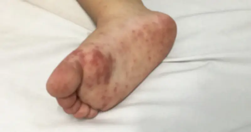 TPHCM cảnh báo bệnh tay chân miệng quay trở lại với tốc độ đáng lo ngại