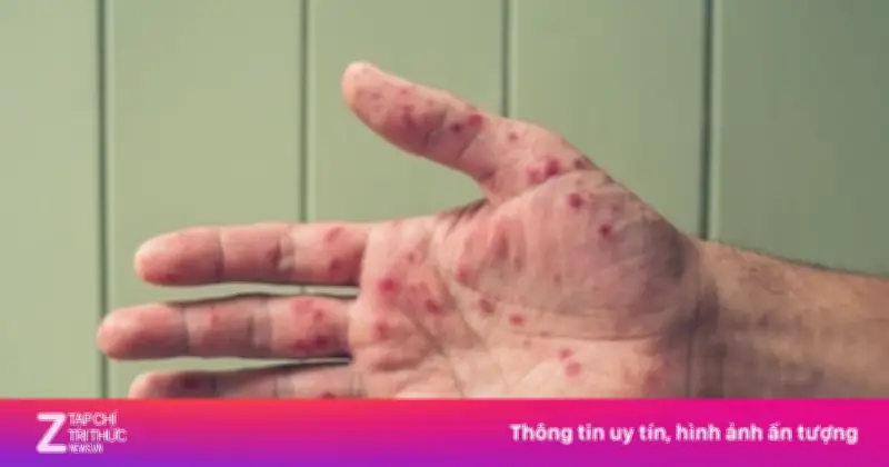 TP.HCM cảnh báo 'sóng dịch' tay chân miệng khi số ca tăng mạnh 38,7% trong tuần