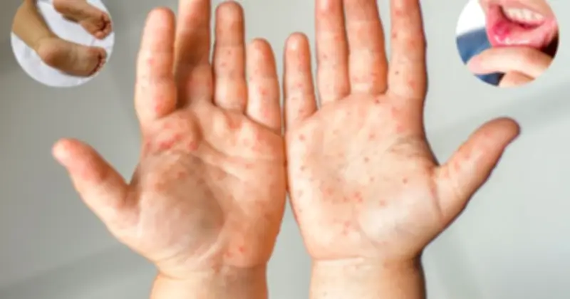 TP.HCM ghi nhận 858 ca tay chân miệng trong tuần, tăng 66,9% so với trung bình 4 tuần trước