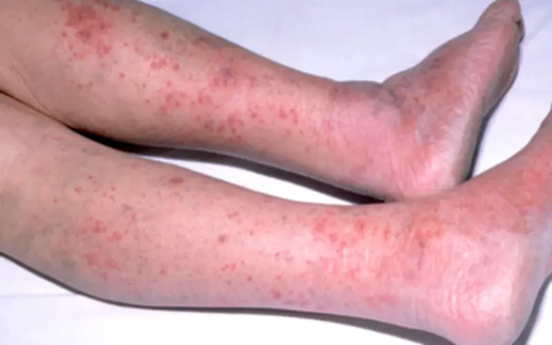 TP.HCM ghi nhận ca viêm màng não do não mô cầu, cảnh báo nguy cơ lây lan nhanh