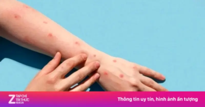 TP.HCM: Số ca tay chân miệng tăng gần gấp đôi, 3 trường hợp không qua khỏi