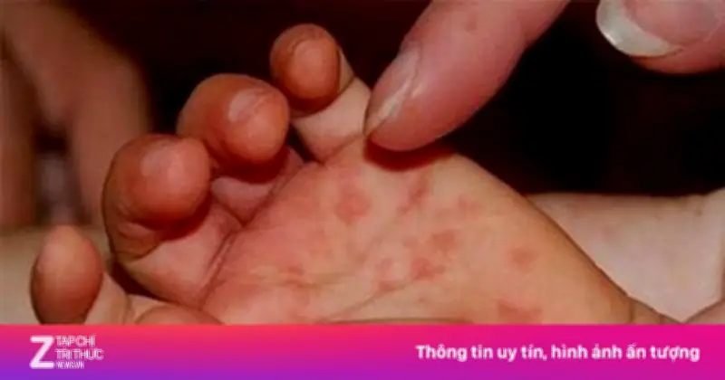 TP.HCM Tăng Cường Giám Sát Dịch Tay Chân Miệng Tại Phường Bình Hưng Hòa