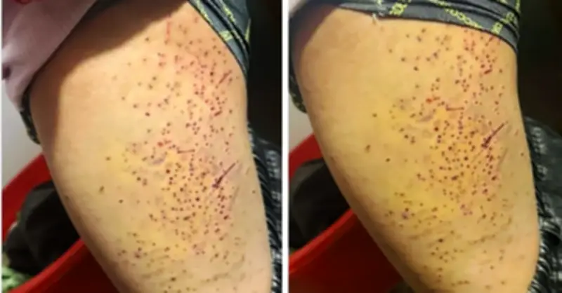 Tranh chấp chỗ ngồi, nữ sinh lớp 7 bị bạn dùng bút bi đâm nhiều lần vào đùi