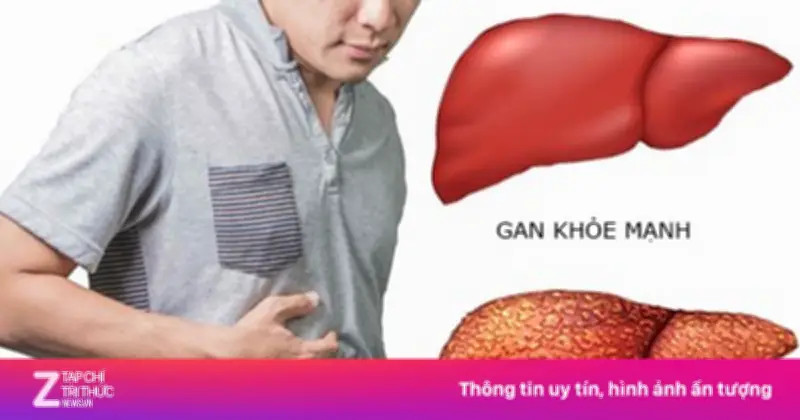 Ung Thư Gan Gia Tăng: Cảnh Báo Từ Virus Viêm Gan Và Lối Sống Không Lành Mạnh