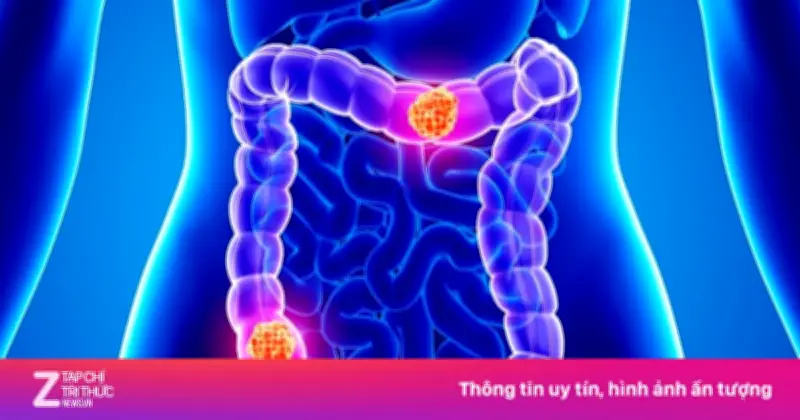 Ung thư đại trực tràng: Kẻ giết người số một ở người trẻ dưới 50 tuổi tại Mỹ