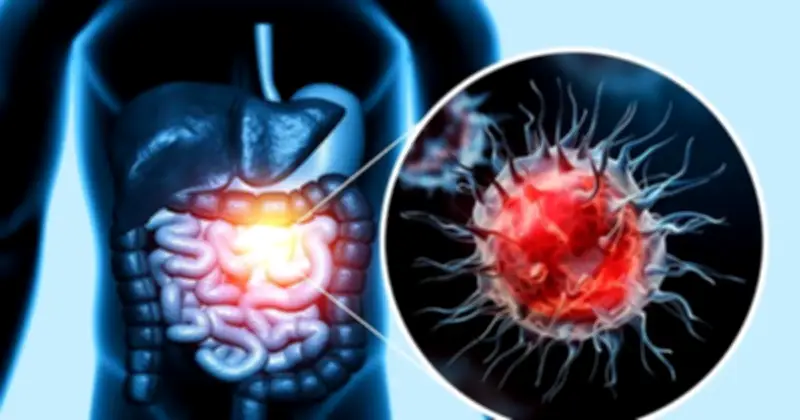 Ung thư đại trực tràng trẻ hóa: Dấu hiệu cảnh báo từ khoang miệng không nên bỏ qua