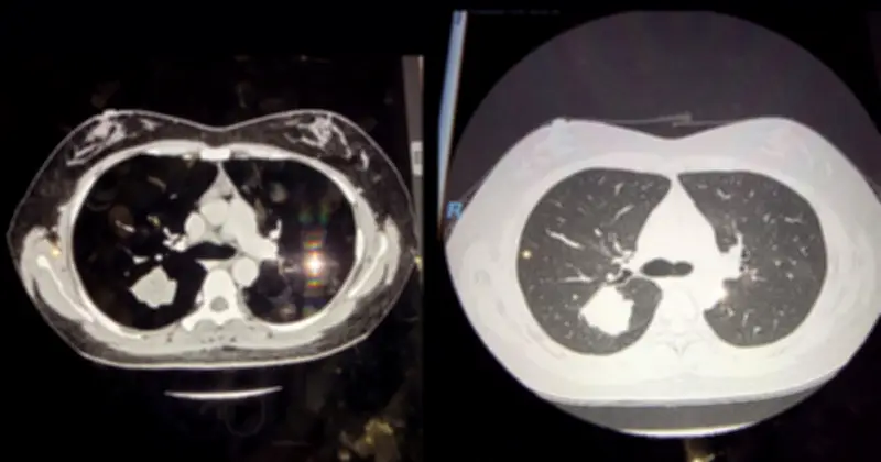 Ung thư phổi: Phát hiện muộn làm tăng nguy cơ tử vong, công nghệ CT mới hỗ trợ chẩn đoán sớm