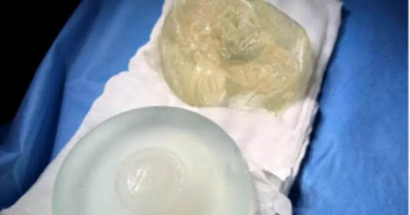 Vỡ Túi Ngực Sớm: Nguyên Nhân, Dấu Hiệu Và Quy Trình Tháo Túi An Toàn