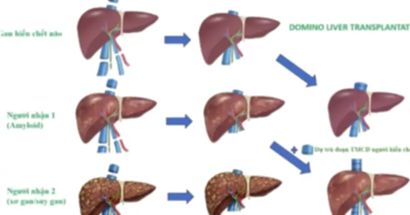 Việt Nam Lần Đầu Tiên Thực Hiện Thành Công Ca Ghép Đa Tạng Domino Phức Tạp