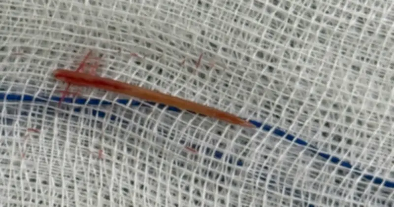 Xương cá 3 cm xuyên ruột non, bệnh nhân may mắn thoát nguy nhờ phẫu thuật nội soi