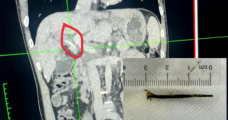 Xương cá 3cm xuyên dạ dày vào gan: Triệu chứng giống ung thư, bệnh nhân lo âu suốt nhiều tháng