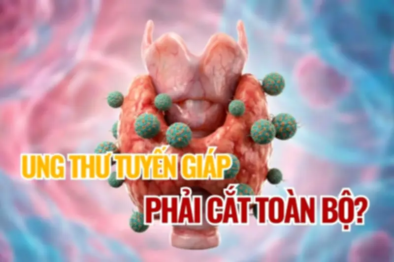 Yếu tố quyết định phạm vi phẫu thuật tuyến giáp cho bệnh nhân ung thư