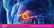 5 triệu chứng cảnh báo ung thư tuyến tụy - 'Vua của các loại ung thư'