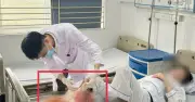 Bệnh nhân bỏng tự đắp lá, suýt mất chân vì hoại tử nặng