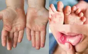 Bệnh tay chân miệng tăng nhanh, xuất hiện biến chứng nguy hiểm: Hướng dẫn cha mẹ bảo vệ trẻ