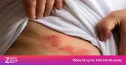Cơn đau zona thần kinh: Hành hạ như dao cắt và nỗi khổ kéo dài hàng thập kỷ