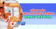 Cảnh báo: Ung thư đại trực tràng đang trẻ hóa, đặc biệt ở trực tràng