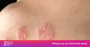 Cảnh giác với 4 biểu hiện lạ trên da có thể là dấu hiệu HIV