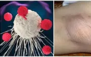 Doanh Nhân 59 Tuổi Phát Hiện Ung Thư Hạch Sau Khi Bỏ Qua Dấu Hiệu Nổi Hạch Ở Nách