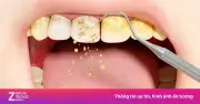 Dấu Hiệu Cảnh Báo Đến Lúc Cần Lấy Cao Răng Để Bảo Vệ Sức Khỏe Răng Miệng